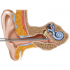 Шунтирование среднего уха (одна сторона)
