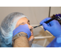 Химическая коагуляция сосудов перегородки носа Химическая коагуляция сосудов перегородки носа