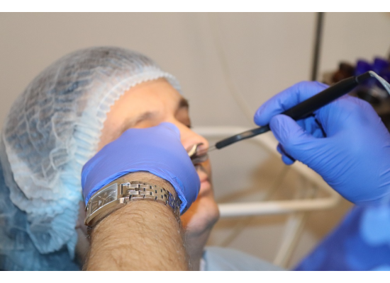 Химическая коагуляция сосудов перегородки носа Химическая коагуляция сосудов перегородки носа