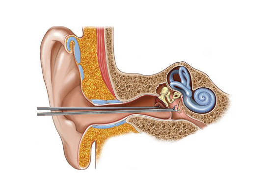 Шунтирование среднего уха (одна сторона)